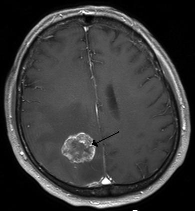 Brain tumor