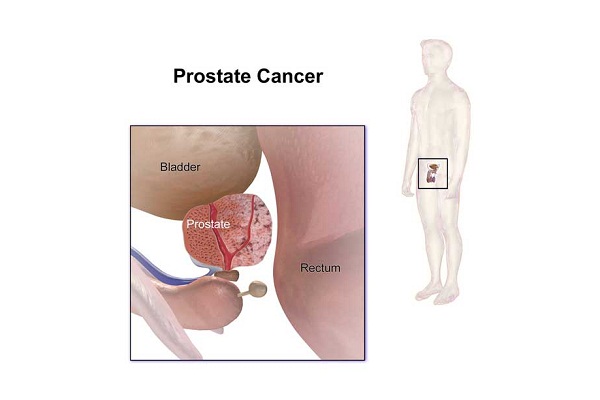 prostate cancer