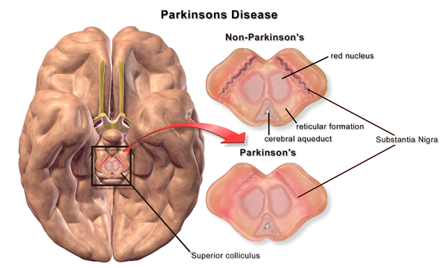 Parkinson’s disease