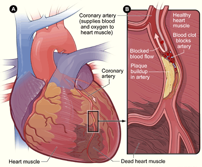 heart diseases