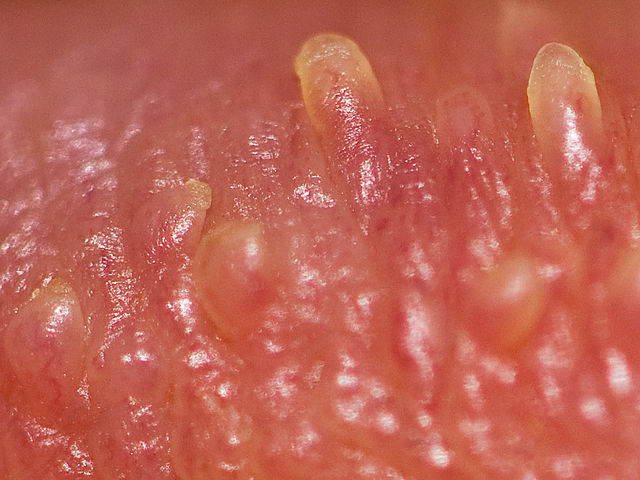 Pearly penile papules