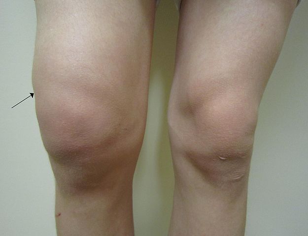 knee problems